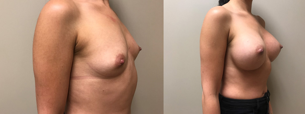 Breast Augmentation Patient 34 | Scottsdale Plastic Surgeon Dr. Shaun Parson