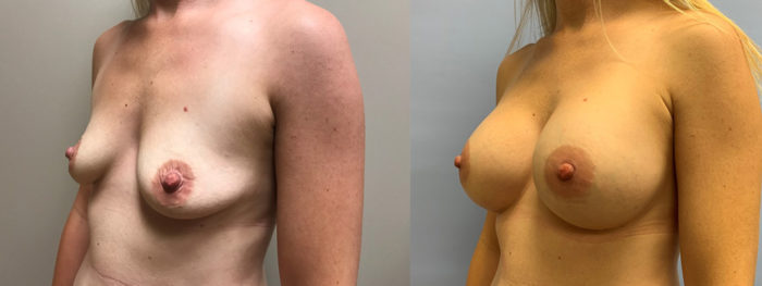 Breast Augmentation Patient 44 | Scottsdale Plastic Surgeon Dr. Parson