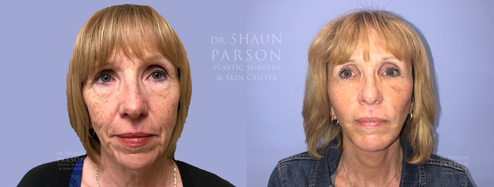 Facelift Patient 21 | Dr Shaun Parson, Scottsdale