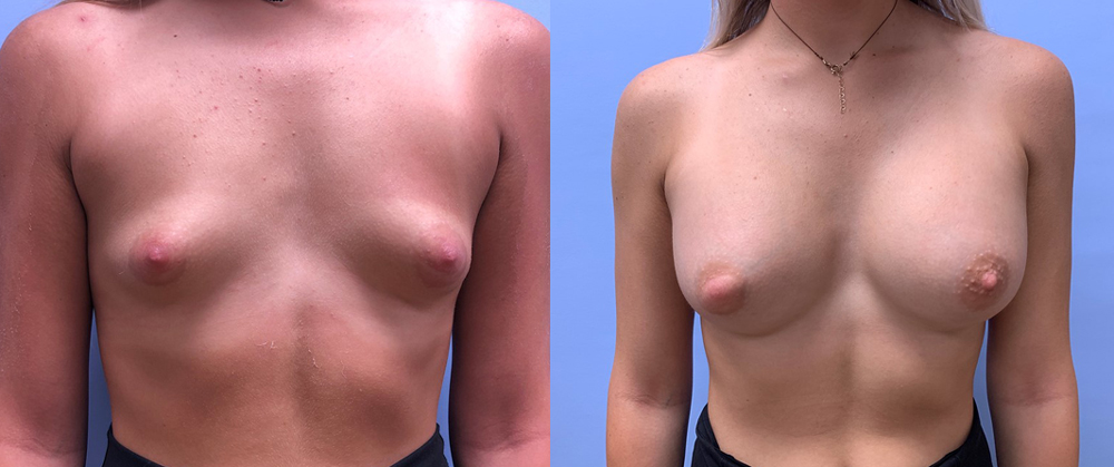 Breast Augmentation Patient 45 | Scottsdale Plastic Surgeon, Dr. Shaun Parson