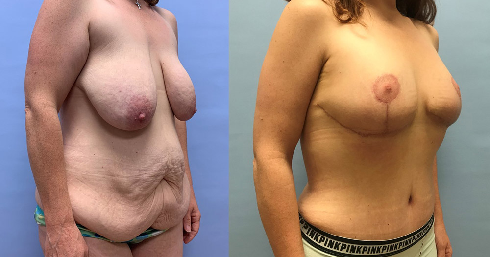 Breast Lift Patient 19 | Scottsdale Plastic Surgeon