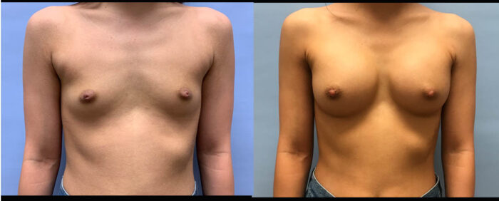 Breast Augmentation Patient 48 | Dr. Shaun Parson Scottsdale, AZ