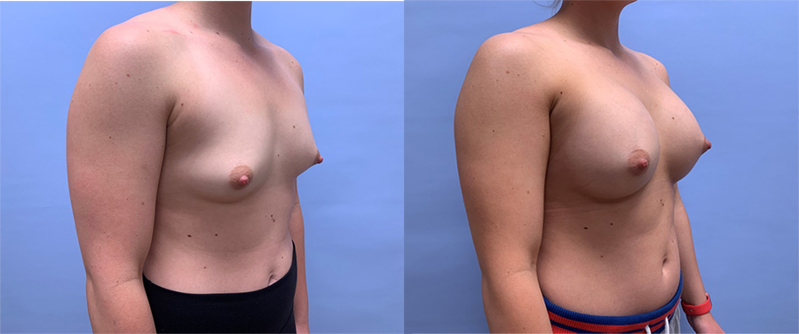 Breast Augmentation Patient 49 | Dr. Shaun Parson Plastic Surgery Patient 49