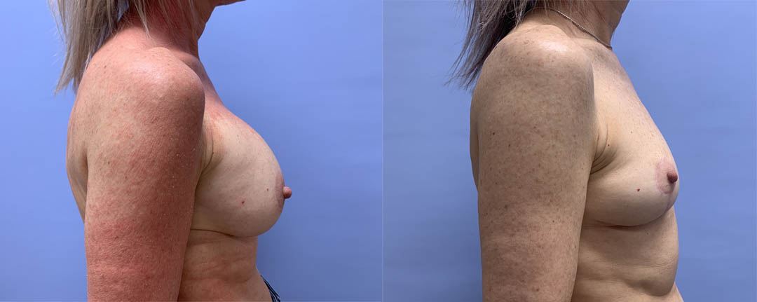 Breast Explant Patient 11 | Scottsdale Plastic Surgeon, Dr. Shaun Parson