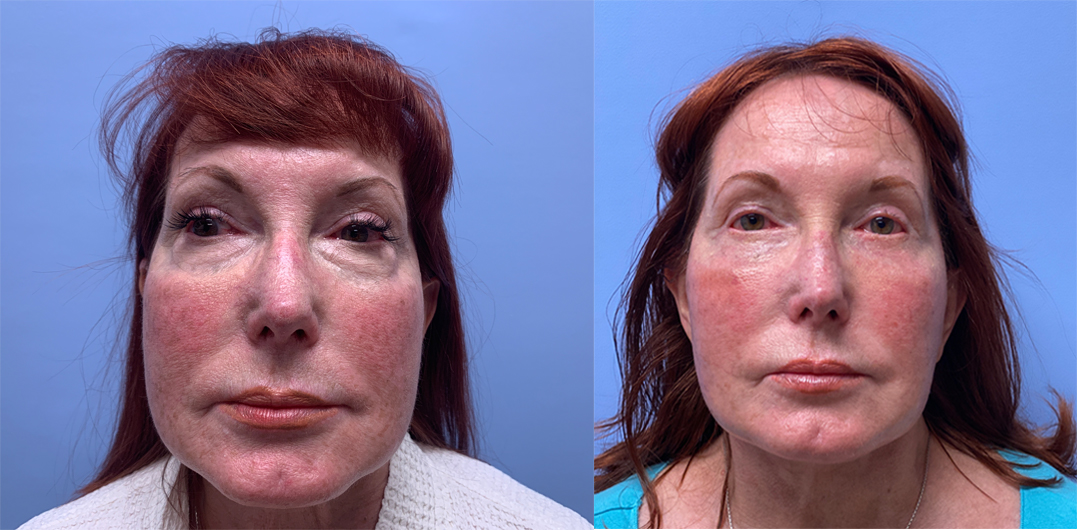 Facelift Patient 23