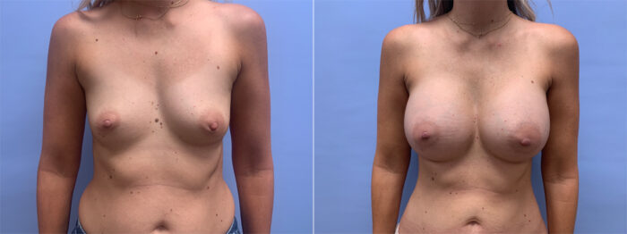Breast Augmentation Patient 51 | Dr. Shaun Parson Scottsdale, AZ