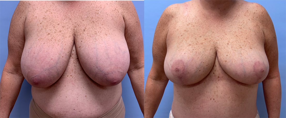 Breast Lift Patient 21 | Dr. Shaun Parson Plastic Surgery, Scottsdale