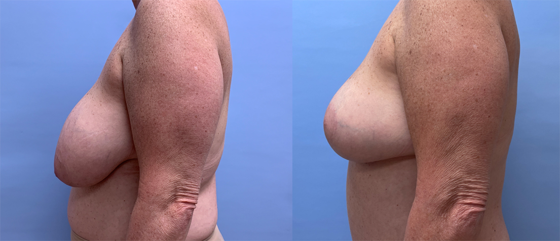 Breast Lift Patient 21 | Dr. Shaun Parson Plastic Surgery, Scottsdale