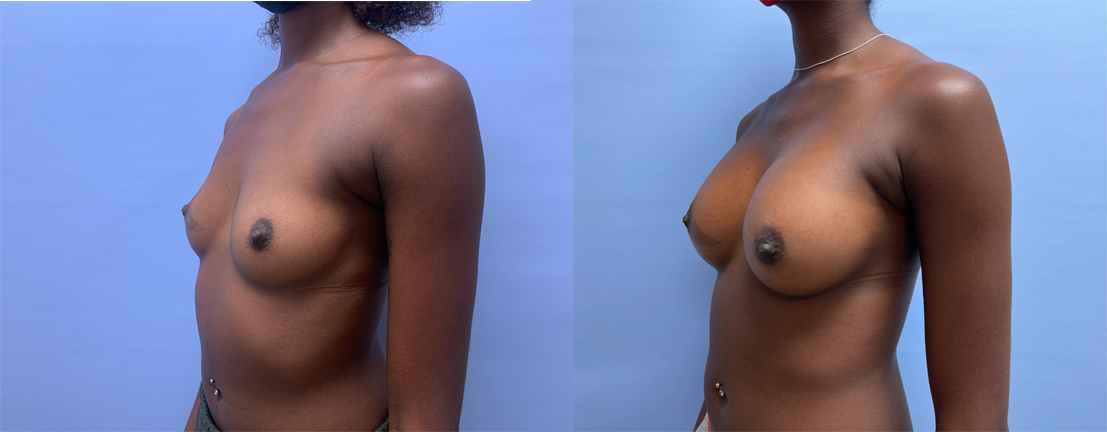 Breast Augmentation Patient 54 | Dr. Shaun Parson Scottsdale, AZ
