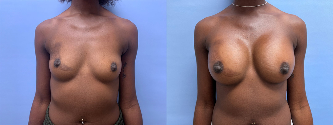 Breast Augmentation Patient 54 | Dr. Shaun Parson Scottsdale, AZ