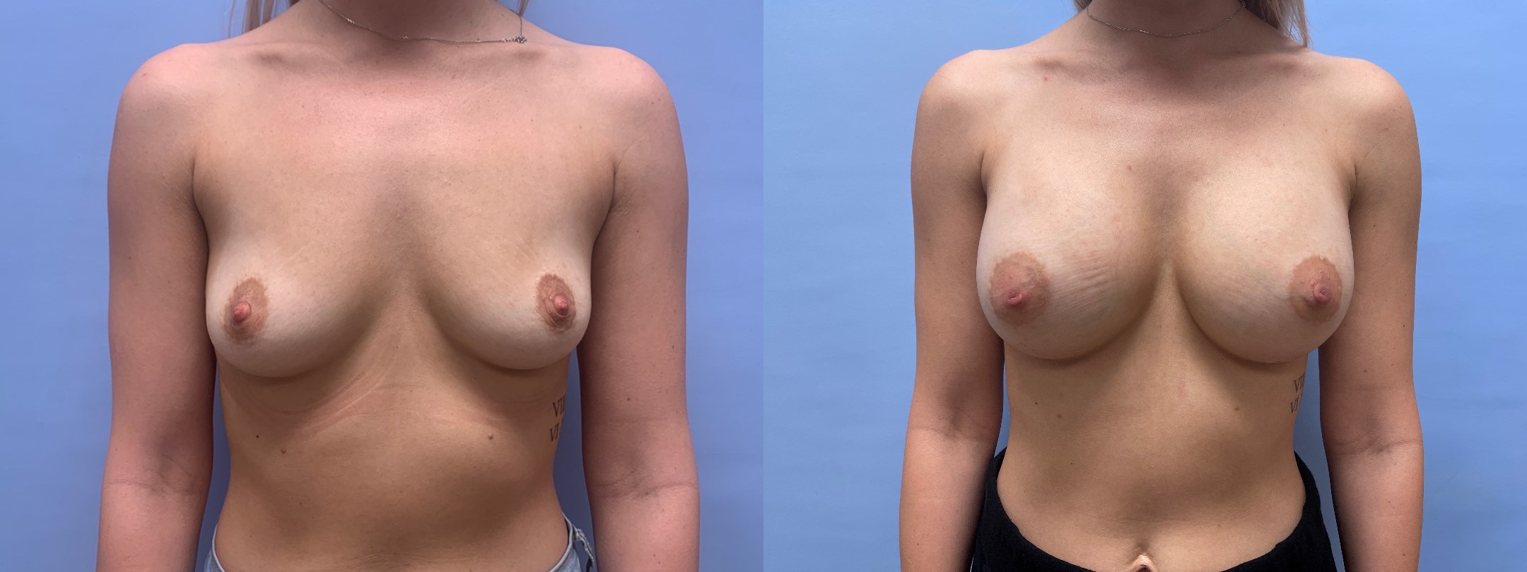 Breast Augmentation Patient 55 | Dr. Shaun Parson Scottsdale, AZ