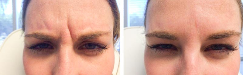 Botox | Dr. Shaun Parson Plastic Surgery and Skin Center | Scottsdale, Arizona