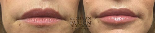Fillers | Dr. Shaun Parson Plastic Surgery and Skin Center | Scottsdale, Arizona