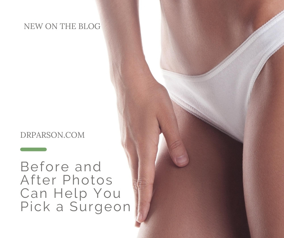 Before and After Photos Can Help You Pick a Surgeon | Dr. Shaun Parson