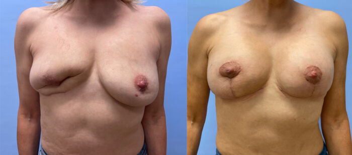 Breast Revision Patient 20 | Dr. Shaun Parson Plastic Surgery and Skin Center