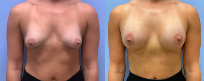 Breast Augmentation Patient 56 | Dr. Shaun Parson, Scottsdale