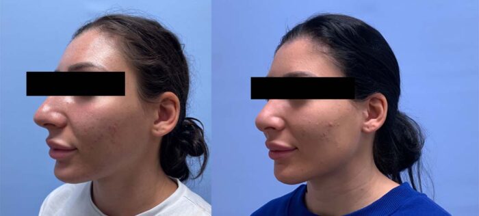 Rhinoplasty 11 | Dr. Shaun Parson Plastic Surgery