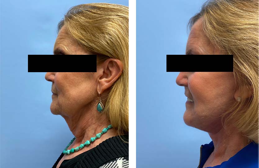 Necklift + Lower Facelift Patient 26 | Dr. Shaun Parson Plastic Surgery