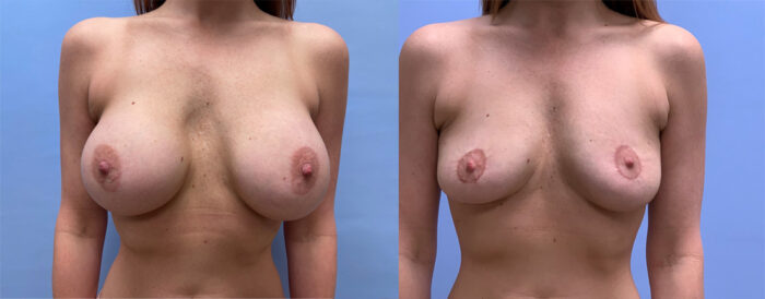 Breast Explant with Fat Transfer Patient 19 | Scottsdale Plastic Surgeon