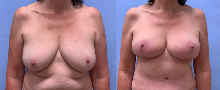 Breast Lift Patient 23 | Dr. Shaun Parson Plastic Surgery
