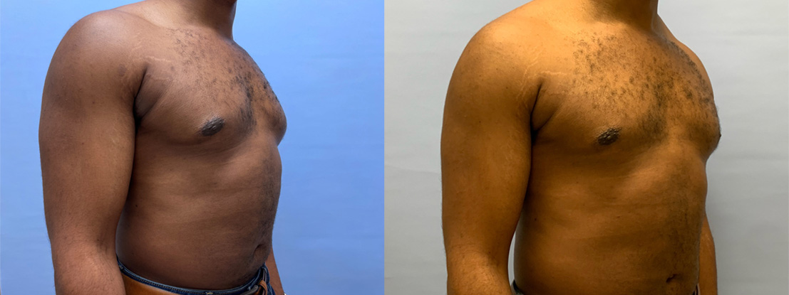 Gynecomastia Patient 19 | Scottsdale Plastic Surgery, Dr. Shaun Parson