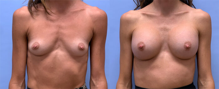 Breast Augmentation Patient 57 | Dr. Shaun Parson, Scottsdale, AZ