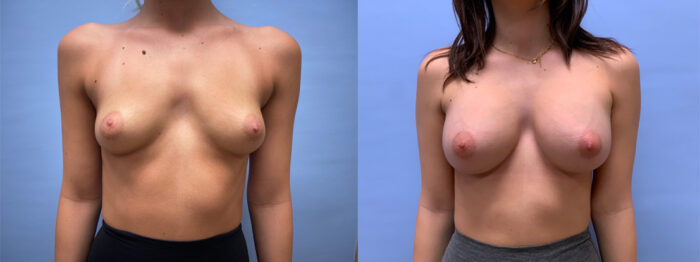 Breast Augmentation Patient 58 | Dr. Shaun Parson, Scottsdale, AZ