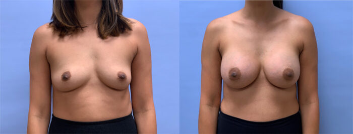 Breast Augmentation Patient 59 | Dr. Shaun Parson, Scottsdale, AZ