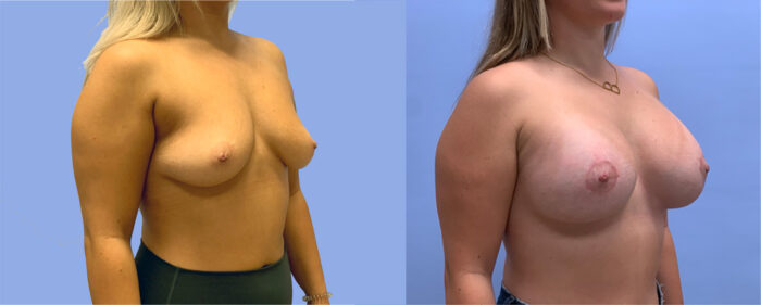 Peri-Areolar Breast Lift with Augmentation Patient 37 | Dr. Shaun Parson, Scottsdale, AZ