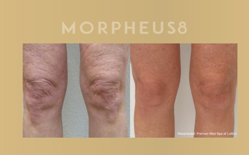 Morpheus8 | Parson Skin Center Scottsdale