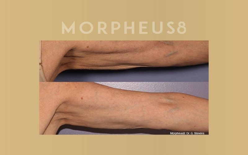 Morpheus8 | Parson Skin Center Scottsdale