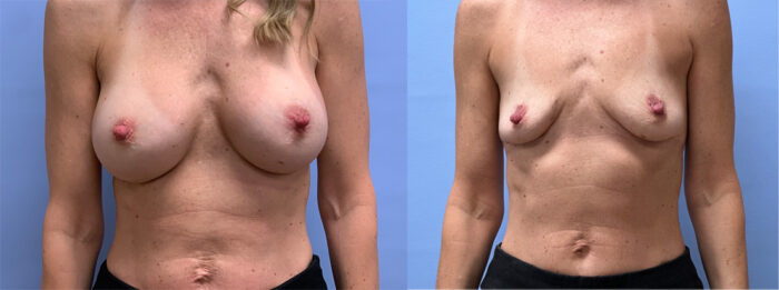 Breast Explant Patient 19 | Dr. Shaun Parson Plastic Surgery