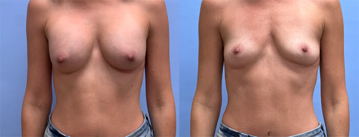 Breast Explant Patient 20 | Dr. Shaun Parson Plastic Surgery and Skin Center