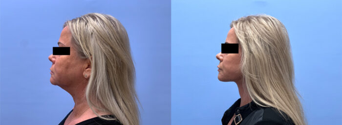 Lower Face and Neck Lift Patient #28 | Dr. Shaun Parson Plastic Surgery