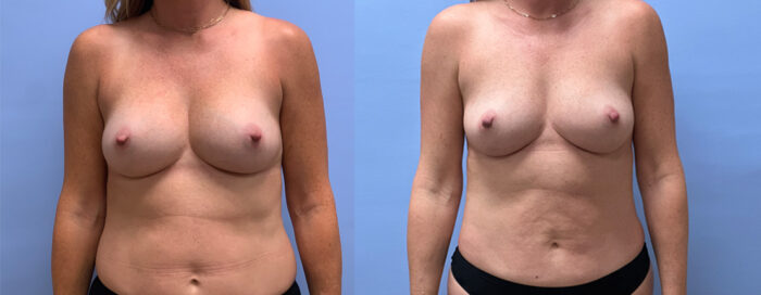 Breast Explant 21 | Dr. Shaun Parson Plastic Surgery, Scottsdale