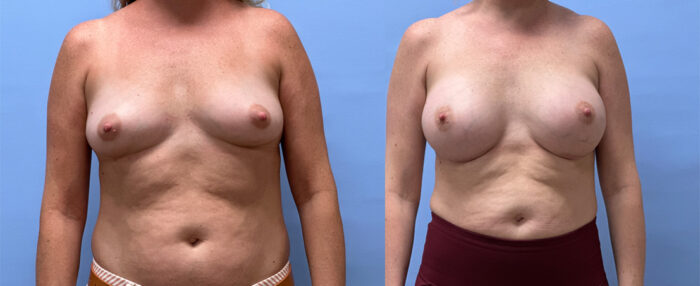 Breast Augmentation Patient 60 | Dr. Shaun Parson Plastic Surgery