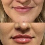 Lip Filler | Dr. Shaun Parson Skin Center, Scottsdale