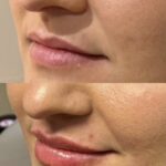 Close-up of lips before and after a cosmetic enhancement.