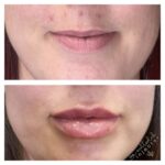 Before and after lip enhancement showing natural and fuller lips.