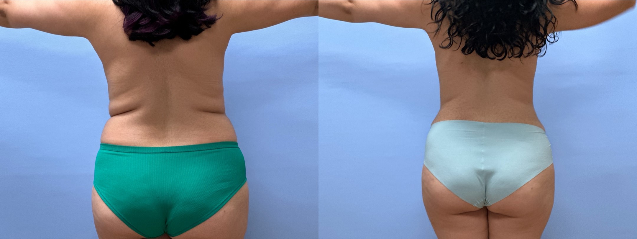 Mommy Makeover Patient 15 | Dr. Shaun Parson Plastic Surgery