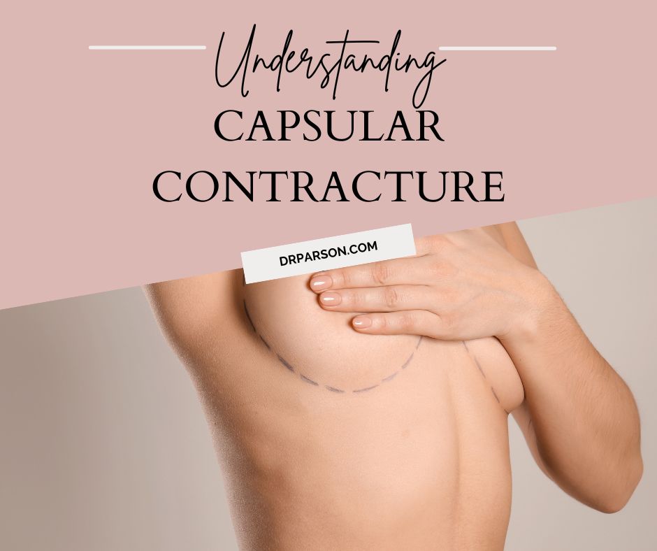 capsular contracture