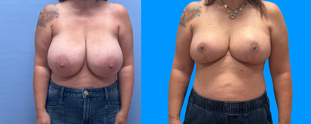 Breast Reduction Patient 28 | Dr. Shaun Parson