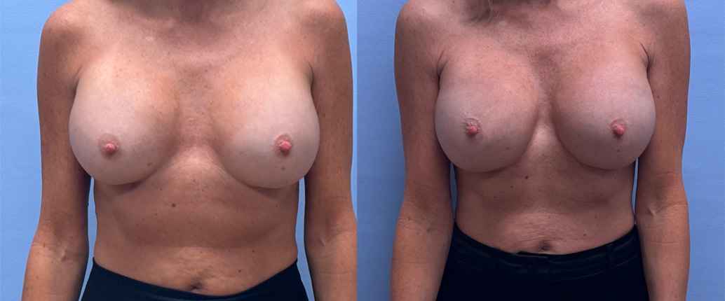 Breast Revision Patient 22 | Dr. Shaun Parson