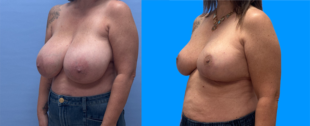 Breast Reduction Patient 28 | Dr. Shaun Parson