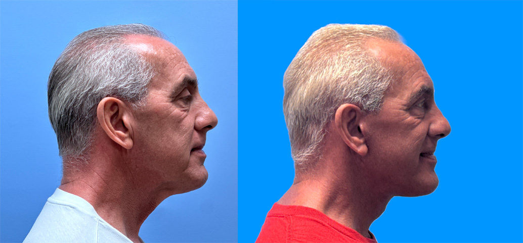 Facelift Patient 39 | Dr. Shaun Parson