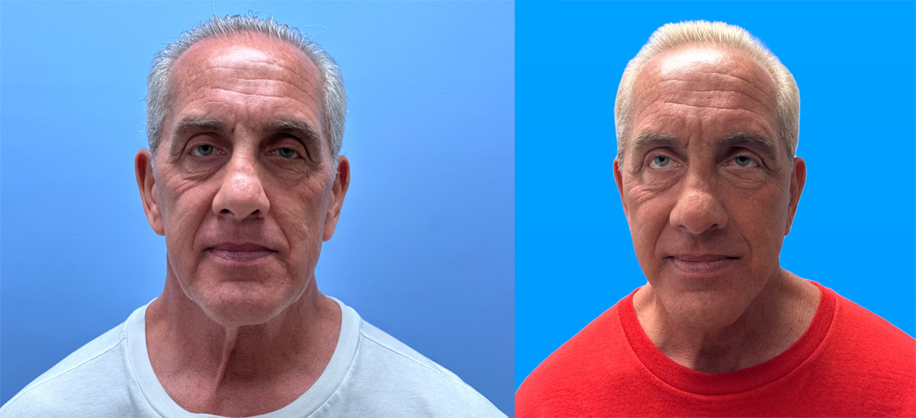 Facelift Patient 39 | Dr. Shaun Parson