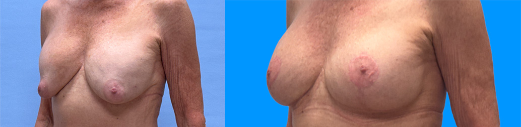 Breast Revision Patient 23 | Dr. Shaun Parson
