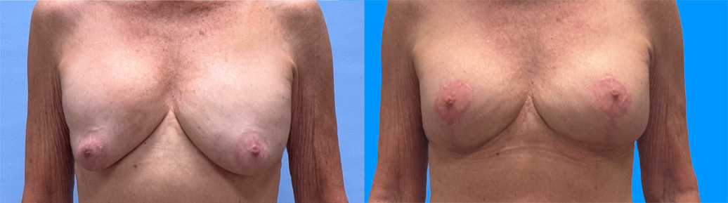 Breast Revision Patient 23 | Dr. Shaun Parson