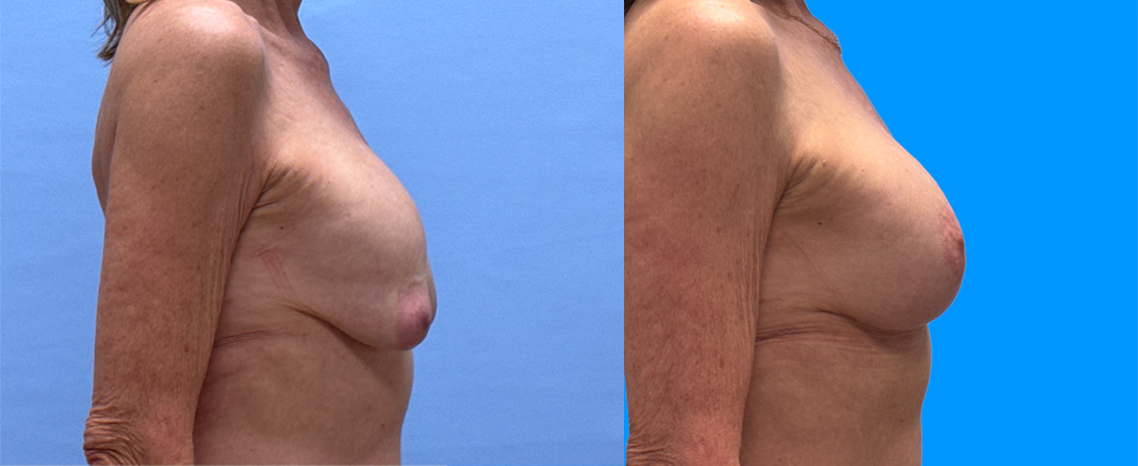 Breast Revision Patient 23 | Dr. Shaun Parson