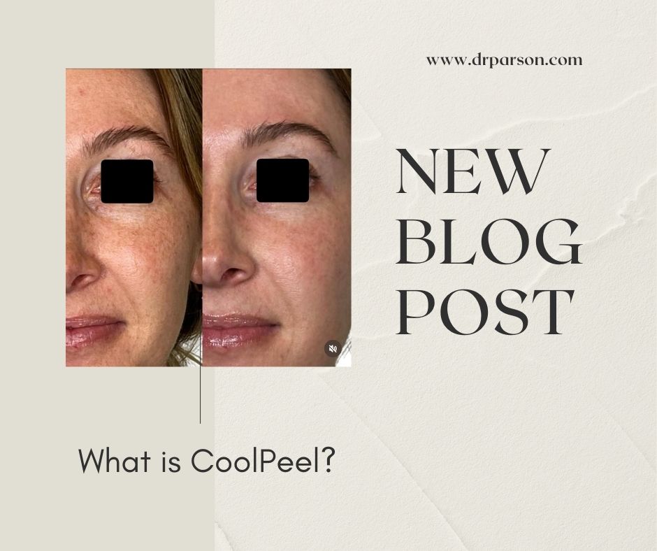 What is Coolpeel